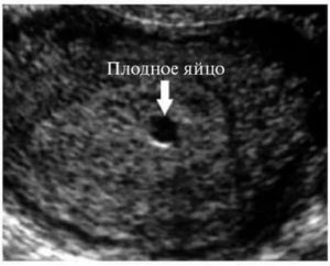 Плодовое яйцо в полости матки не лоцируется