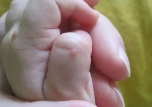 Прыщики на пальцах у младенца