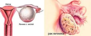Киста или рак?
