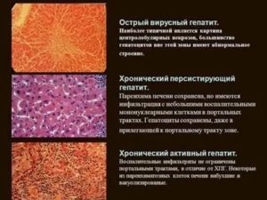 Хронический гепатит В (ремиссия) и ЭКО