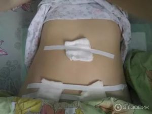 Месячные после лапароскопии, зуд