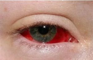 Красные сосуды в белке глаза
