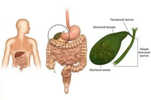 Крапивница и патология желчного пузыря взаимосвязь