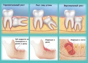 Боль от зуба мудрости или нет?