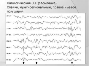 Расшифровать результаты ЭЭГ, РЭГ