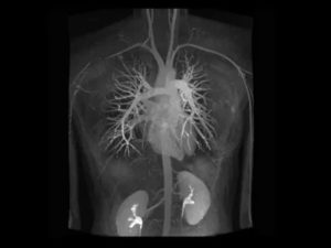 Можно ли делать МРТ при стентах на сосудах сердца