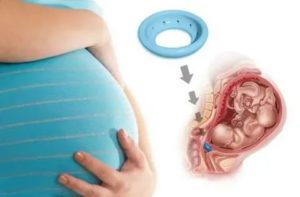 Короткая шейка матки 27 недель беременности
