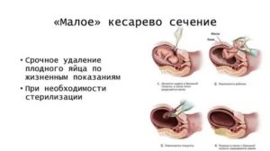Медикаментозный аборт после кесарева
