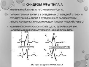 WPW синдром