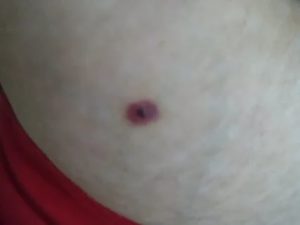 Красная точка по средине соска