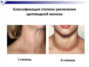 Увеличена левая доля щитовидной железы