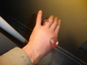 Воспаление и боли в ноге - после прижигания жидким азотом