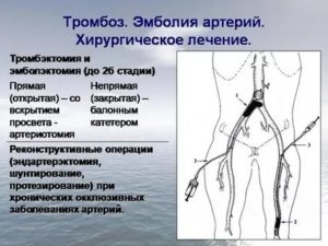 Признаки окклюзивного тромбоза лучевой артерии