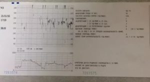 Помогите расшифровать КТГ на 36 неделе