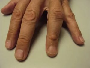 Кожистые наросты на суставах пальцев руки у ребёнка