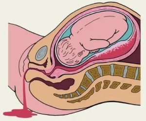Выделения при беременности при низком плацентации!