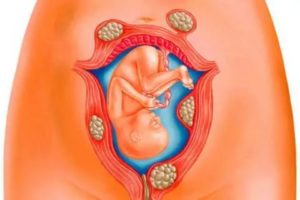 Признаки беременности при миоме