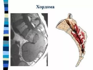 Хордома крестца