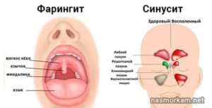 Больно глотать, болит горло и ухо