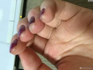 Водянистые пузырьки вокруг ногтя и на подушечках пальцев под ногтем
