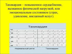Хроническая тахикардия после испуга