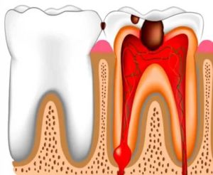 Боль в переднем зубе при периодонтите