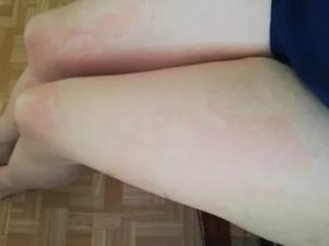 Красные пятна на ногах как ожоги