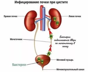 Воспаление почек при орви?