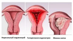 Кровотечение и гиперплазия эндометрии