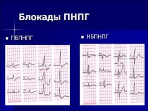 Блокада правой ножки пучка Гиса