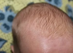Корочки и шелушение на голове у ребенка