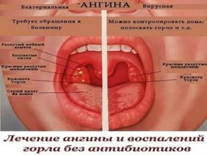 Возможно ли появление ОРВИ после ангины?