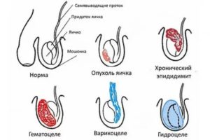 Ушиб яичка у ребенка