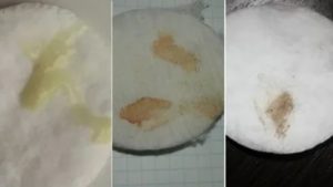 Кровянистые выделения при задержке