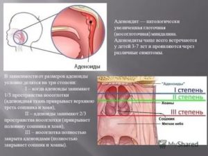 Как вылечить аденоиды 1-2 степени