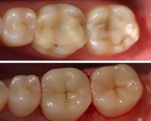 Больно ли менять пломбу на живом зубе?
