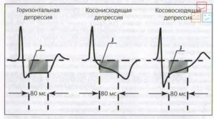 Депрессия сегмента ST, признак феномена CLC и ЭС