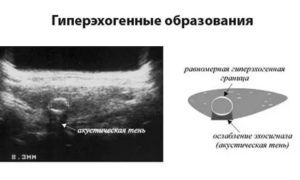 Гиперэхогенное образование с кровотоком при ЦДК