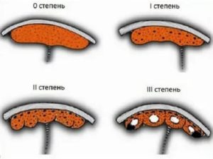 Преждевременное старение плаценты + кальциноз