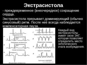 Экстрасистолы