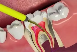 Болят нижние зубы при удалении нерва в верхнем