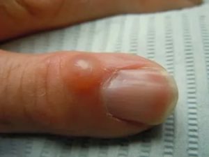 Полупрозрачная шишка возле ногтя на пальце руки