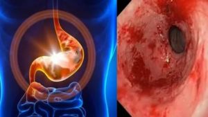 Недостаточность кардии, гастрита, дуоденита