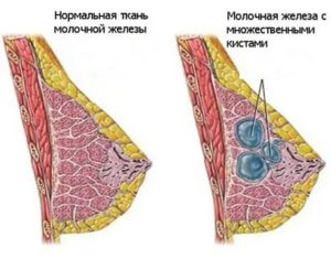 Грудь перед месячными твёрдая