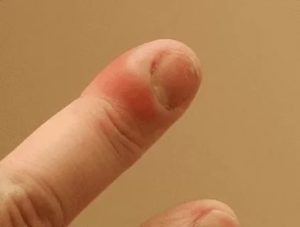 Воспаление на пальце у ребенка