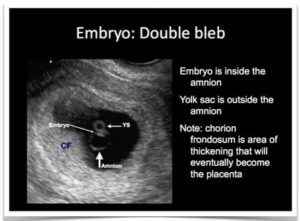 Не лоцируется эмбрион