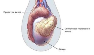 Уплотнение на придатке яичка