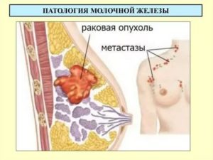 Уплотнение в верхней части груди