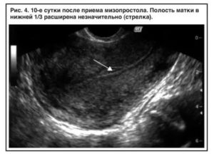 После медикаментозного прерывания беременности