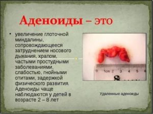 Как вылечить аденоиды 1-2 степени